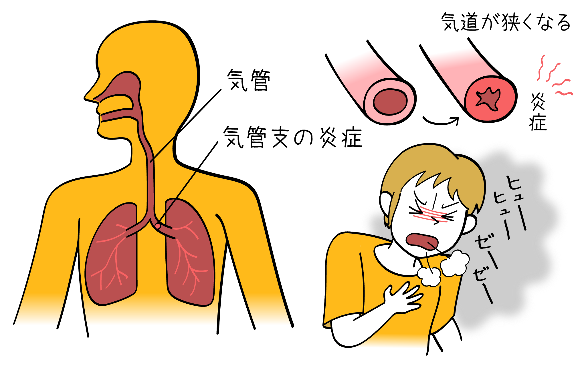 気管支喘息の症状や原因について内科専門医が詳しく解説したイラストになります。